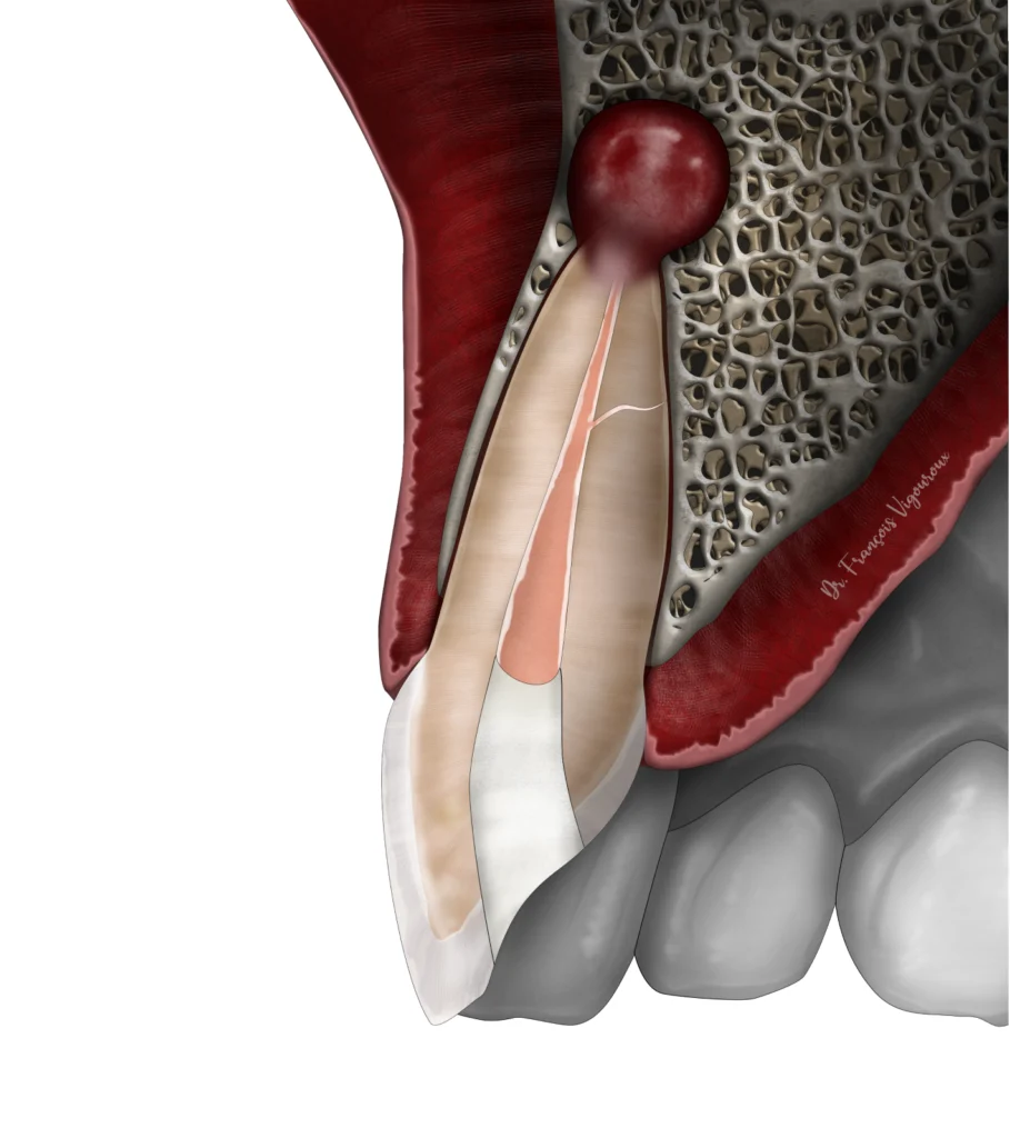 La micro-chirurgie endodontique au Cabinet EndoSpé, endodontie exclusive à Paris 15ᵉ