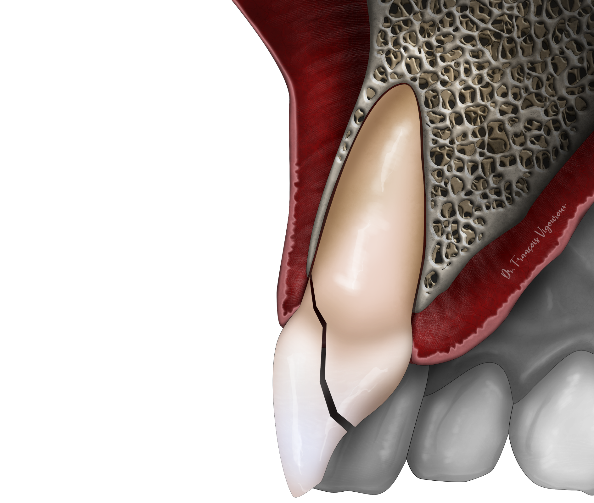 Les traumatismes dentaires au Cabinet EndoSpé, endodontie exclusive à Paris 15ᵉ