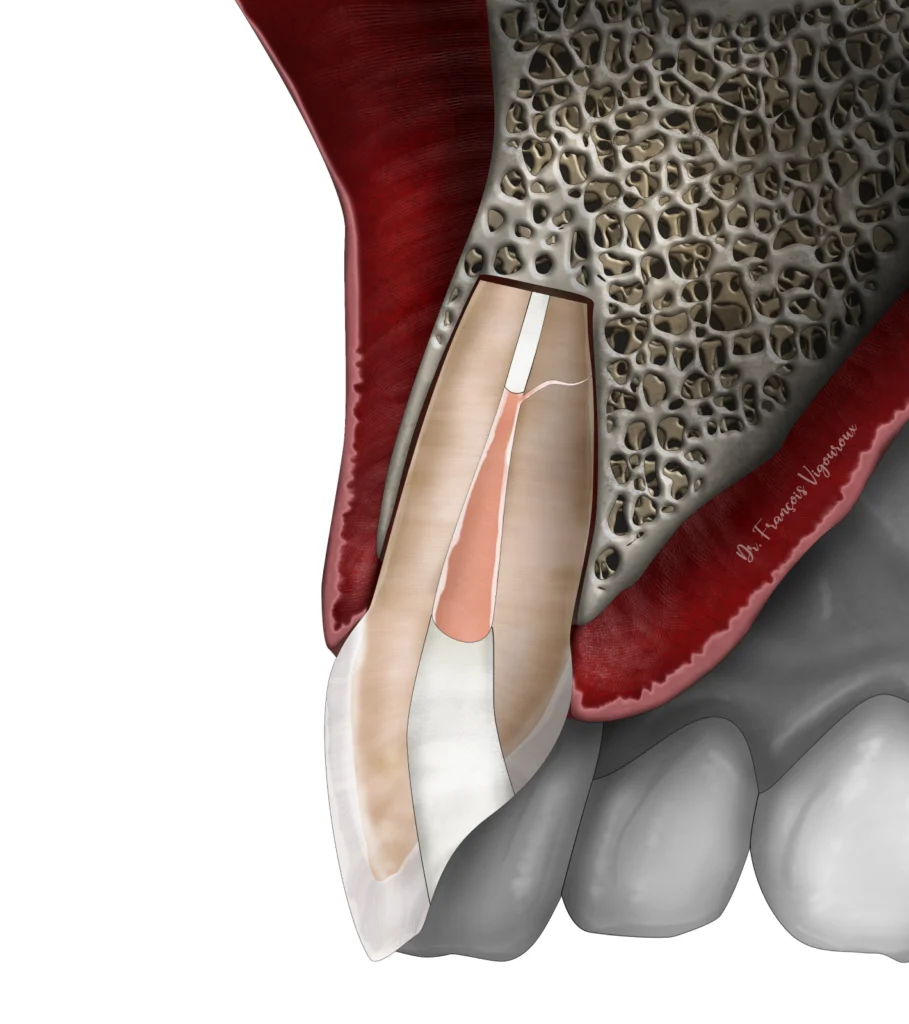 micro-chirurgie endodontique