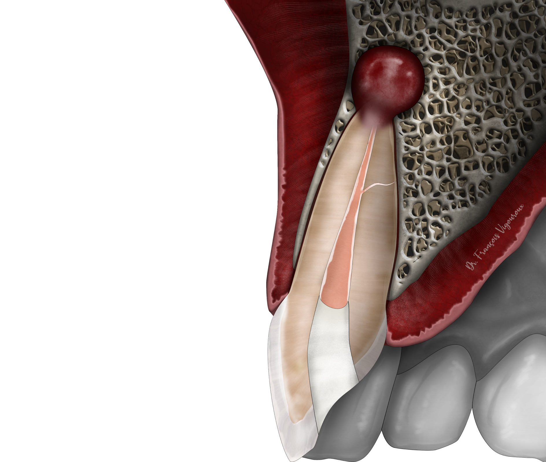 La micro-chirurgie endodontique au Cabinet EndoSpé, endodontie exclusive à Paris 15ᵉ
