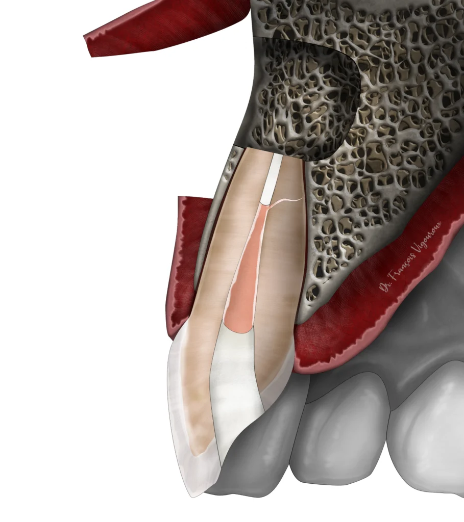 micro-chirurgie endodontique