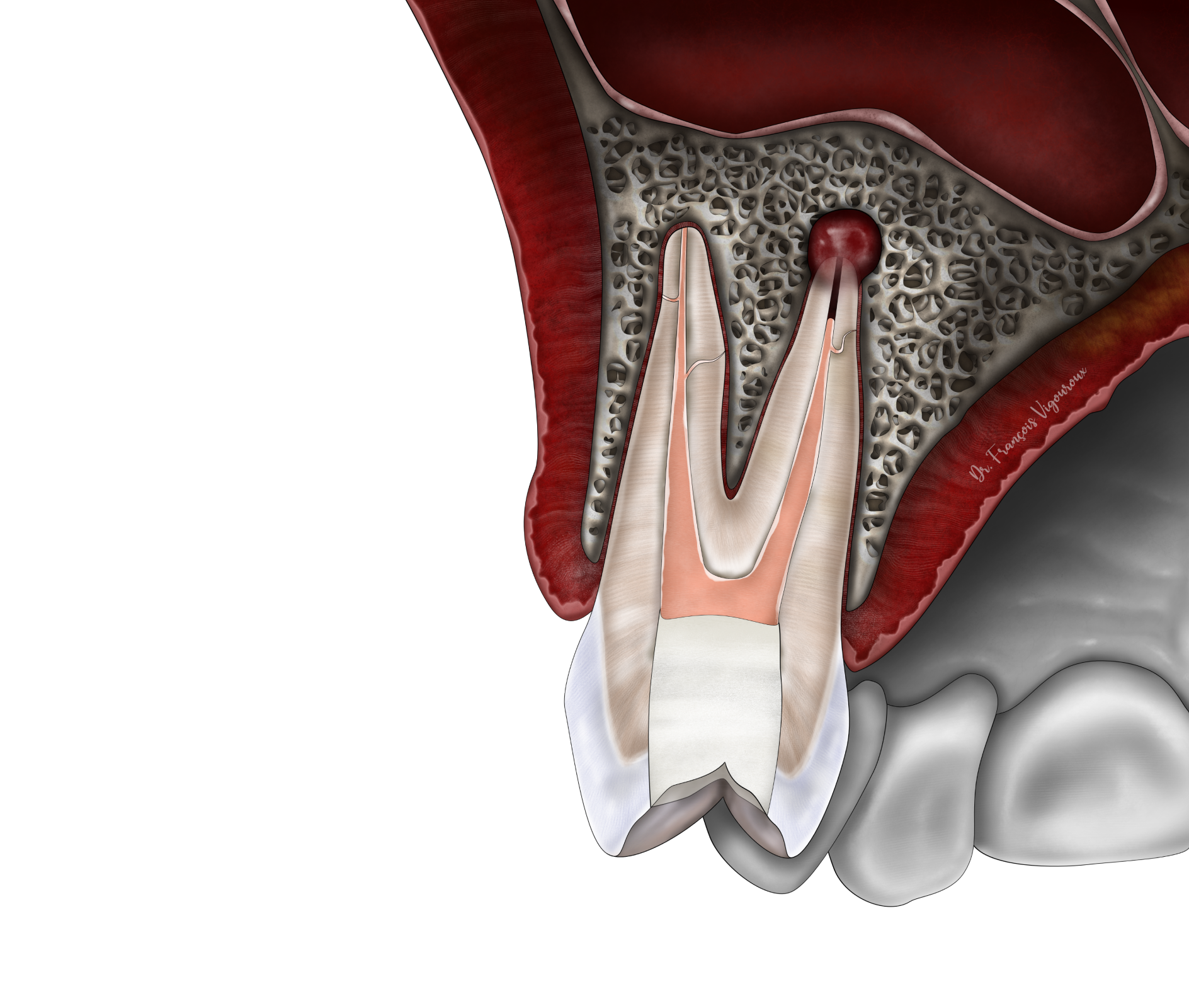 Le retraitement endodontiquе au Cabinet EndoSpé, endodontie exclusive à Paris 15ᵉ