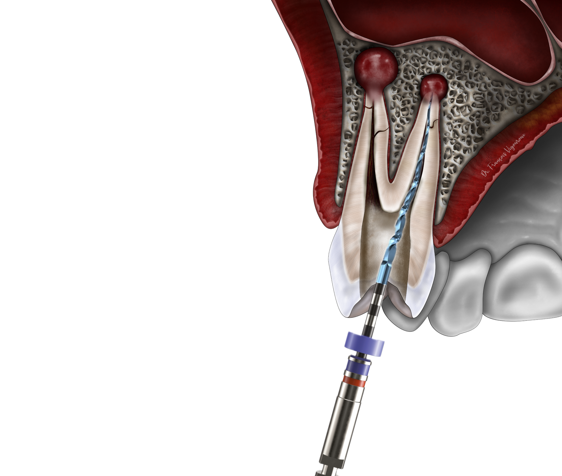 Le traitement endodontique au Cabinet EndoSpé, endodontie exclusive à Paris 15ᵉ