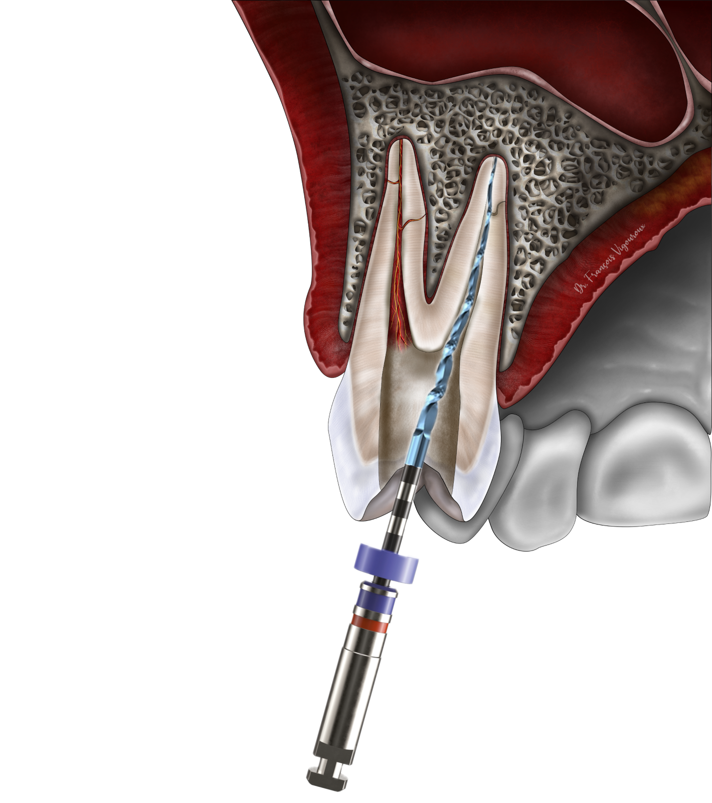 traitement endodontique