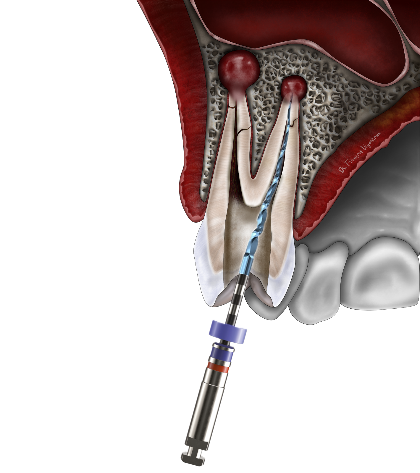 traitement endodontique
