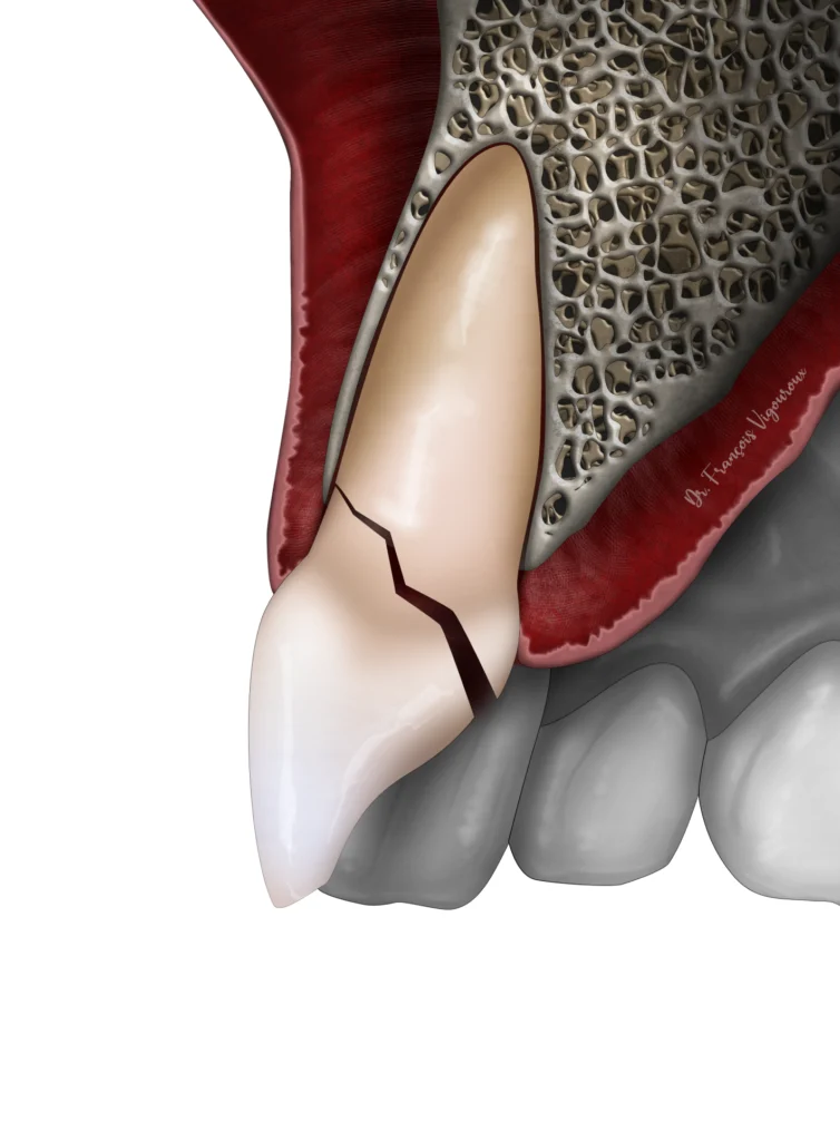  traumatisme dentaire