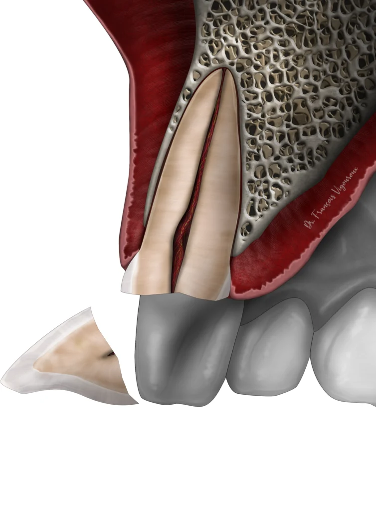  traumatisme dentaire